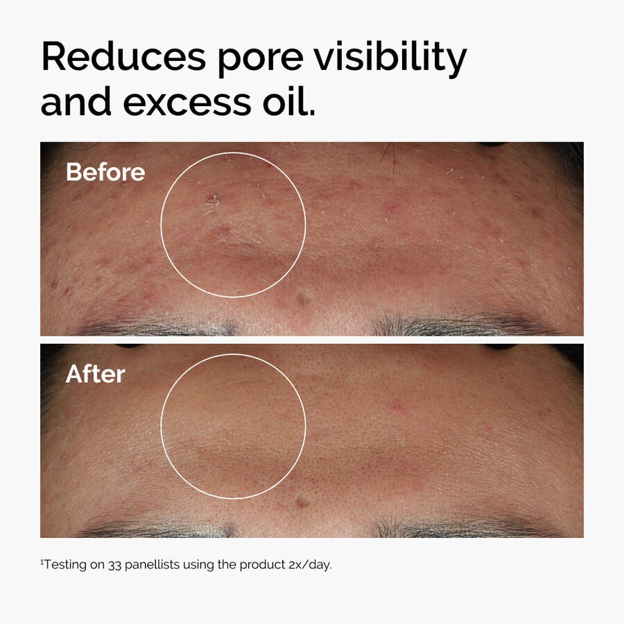 niacinamide-10-zinc-1-e4 ord-niacinamide-zinc-blemish-serum-before-after-pores.jpg