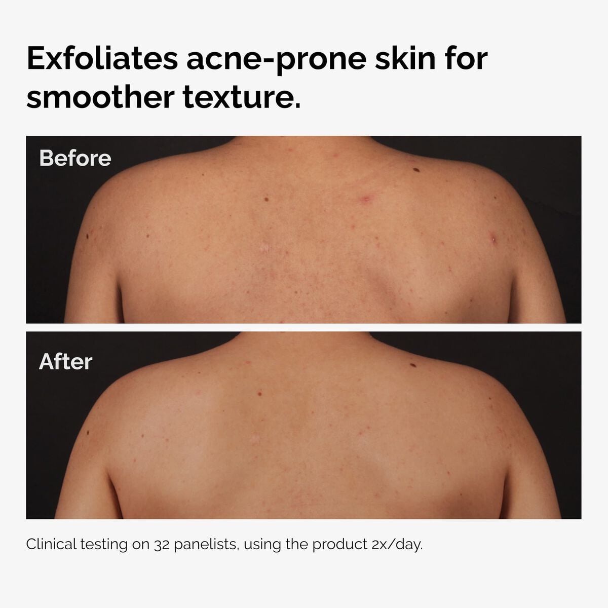 salicylic-acid-0-5-body-serum-e3 ord-salicylic-acid-body-serum-before-after-graphic-NA.jpg